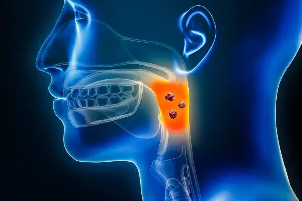 Low Cost Throat Cancer Treatment in India